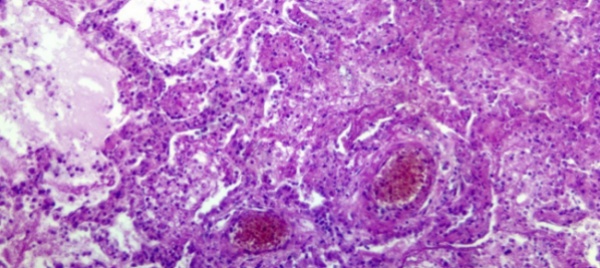 e-bernese-il-nuovo-approccio-terapeutico-contro-leucemia