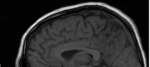 svegliare-i-fantasmi-per-predire-peggioramenti-del-parkinson