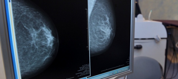 lugano-non-diagnostica-il-tumore-al-seno-a-processo